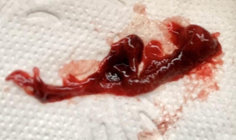 Kiedy do szpitala przy poronieniu