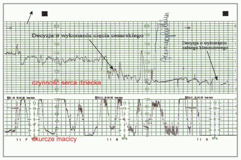 Kiedy najlepiej udać się na badanie KTG? Poradnik dla przyszłych mam